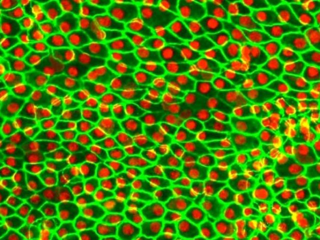 Stem Cells Treat Macular Degeneration